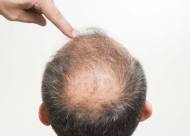 掉头发厉害的原因 推荐5个治疗掉头发的食疗偏方