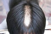 脱发发根有小白点是什么？脂肪粒堆积的消除方法