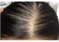 男性和女性脂溢性脱发有什么不同？讲述各个阶段的表现症状
