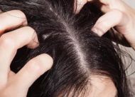 日常我们该怎么调理脂溢性脱发？详谈五个实用方法