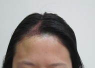 疤痕植发5个月的效果怎么样  疤痕植发的优势有哪些