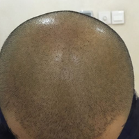 禿頂用戶圖片