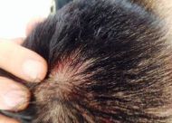 头皮毛囊炎会导致脱发吗？生活中需要注意这五点