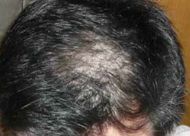 脂溢性脱发常发生于那个年龄？常见的四种类型脱发