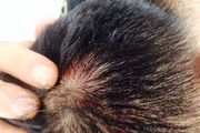 局部脱发的原因有哪些？日常两点要注意