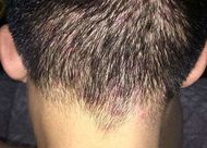 后腦勺脫發(fā)怎么治療？原來是這五個原因導致
