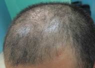 毛发种植术后护理不当会出现哪些副作用？手术的六个必要过程