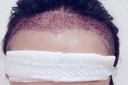女性植发后多久可以看到效果？只需熬过三个阶段