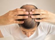毛发种植后的毛发自然度会受哪些因素影响？总结五大因素