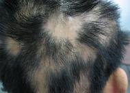 疤痕性脱发怎么治疗效果*好？来看看是不是四个因素导致