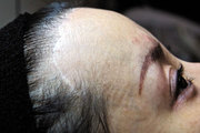 医生的技术水平对植发的比较终效果影响大吗?看能否满足这五点