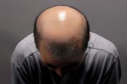 怎么看自己是不是快秃顶了？治疗脱发的医学手段