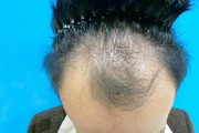 头顶稀疏到什么程度需要做加密植发?日常四点不可忽视