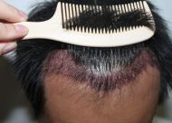 治疗脱发是用药物好还是植发手术更好？各个阶段的用法不一样