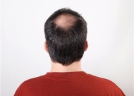 什么是病理性脱发？日常防治的五种方法