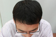 冬天做植发手术会影响术后的效果吗？这篇文章能帮到你