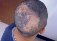 头部有烧伤能采用疤痕种植术来补救吗？常见的五种类型