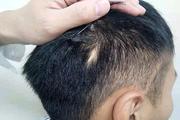 做植发手术有用吗？哪些问题应该要注意