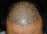 種植頭發(fā)到底好不好？發(fā)際線調(diào)整價格貴不貴?