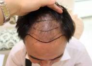 哪些脱发类型比较适合毛发移植手术？你是这六类之一吗