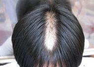 脱发患者中为什么男性居多？男性头顶秃发的根源是什么