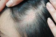 女性出现头顶脱发自己能恢复吗？这四大诱因是根源
