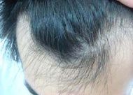 種植頭發(fā)為什么不能用人的毛囊？只能選擇后枕部的毛囊嗎