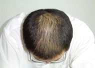 植发后取发区的头发会不会变少？提取后枕部毛囊的两个原因