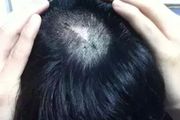 疤痕植发和普通植发有什么不一样 疤痕处植发要注意什么
