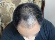 植发后遗症有哪些 如何走出植发后遗症的误区