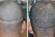 疤痕植发贵吗 植发失败的特征有哪些
