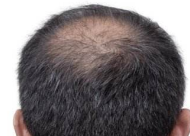 疤痕性脱发的常见原因有哪些 疤痕性脱发怎么预防