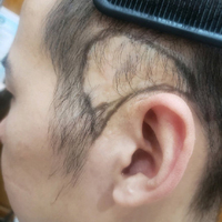 疤痕植發(fā)用戶圖片
