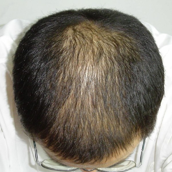 遗传性脱发几年了,想做植发,广州哪个植发医院好一点呢?
