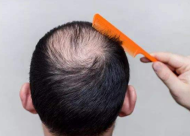 神经性脱发可做头发种植吗 头发种植的适应症有哪些
