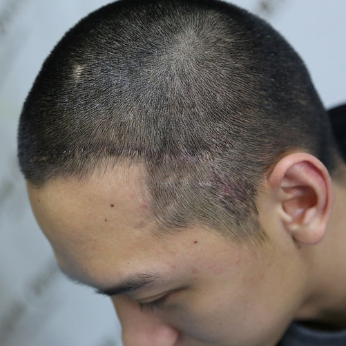 疤痕植发半年多了现在大量的掉发这是怎么回事?