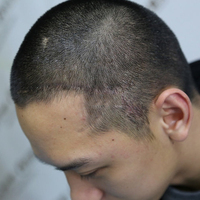 疤痕植發(fā)用戶圖片