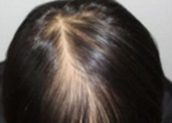 脱发不治疗会自愈吗 哪些脱发类型是可以自愈的