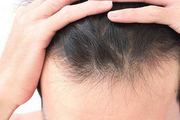 种植发际线是永jiu的吗 植发际线以后会不自然吗