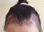 女性植发后15天能洗头吗 女性植发后头肿了多久能消