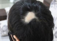 头部有灼伤能采取疤痕种植吗 疤痕修复植发是什么原理