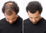 头发油影响植发吗 植发后头油要怎么办「植发护理」