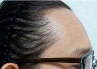 m型发际线一定会秃顶吗 爸爸的m型发际线会遗传吗