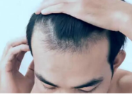 发际线植发后遗症有哪些 这六点可以了解一下