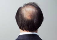 男人头顶脱发的原因有哪些 可能与这四个因素有关