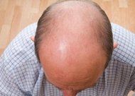 秃顶还能植发吗 秃顶植发安全吗 秃顶植发副作用