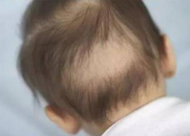儿童脱发的原因有哪些 如何有效预防儿童脱发