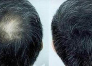植发后脱发多久再长 植发后脱落期怎么护理头发