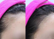 女性植发的恢复周期是多久 植发的优缺点有哪些