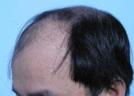 化学性脱发的原因有哪些 化学性脱发会自愈吗